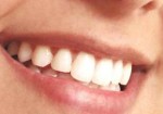 implantes-dentarios-augusta-1363717433